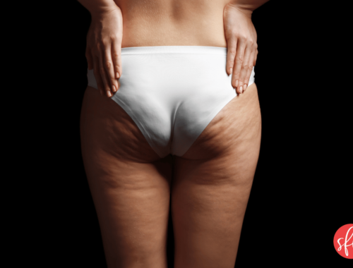 The topic of eliminating cellulite with fat loss.